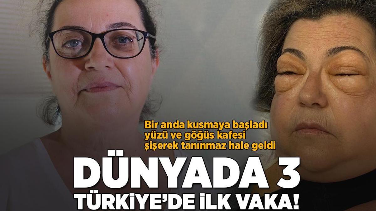 Dünyada 3, Türkiye’de ilk vaka! Yüzü tanınmaz hale geldi doktorun şüphesi doğru çıktı