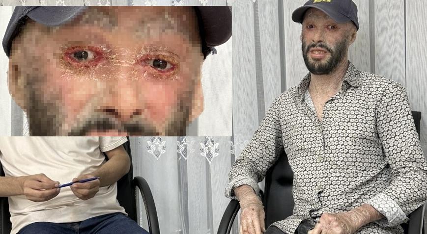 Tedavisi 3 ay sürdü! Hakkarili iktiyozis hastası Refik’ten haber var