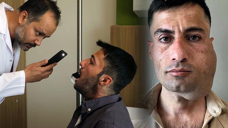 Yüzündeki tümör 12 saatlik ameliyatla alındı