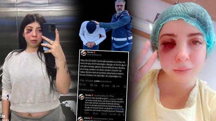 Taciz edildi, sokak ortasında dövüldü: Artık yüzümün sol tarafını hissetmiyorum